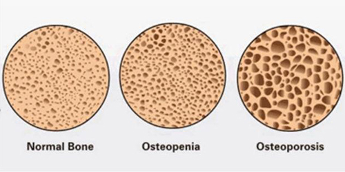 home-remedies-for-osteopenia-img8